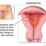 Endometritis