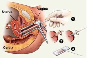 Cervical-cancer-treatment